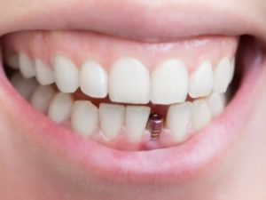 Восстановление зубов с помощью имплантации в Саратове